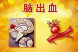 寒冷天气易引发脑出血 预防关键在于控制血压